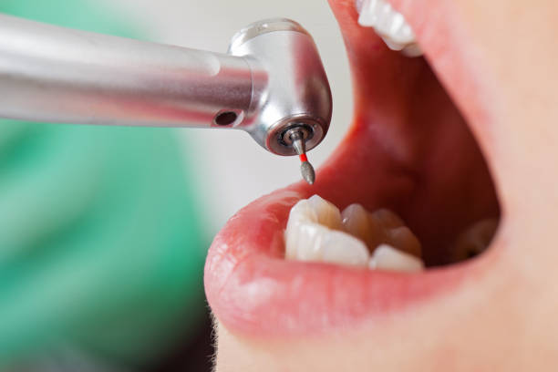 Best Emergency Wisdom Teeth Removal in Nicholson, MS